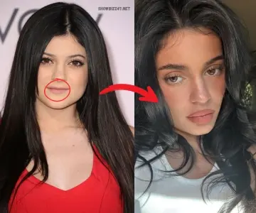 Kylie Jenner Before and After: A Transformation Journey Kylie Jenner Lip Transformation